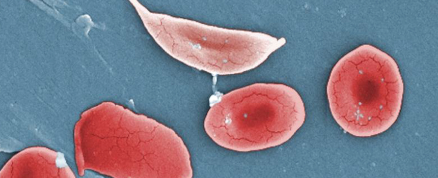 BioCentury - New SOC in sickle cell?